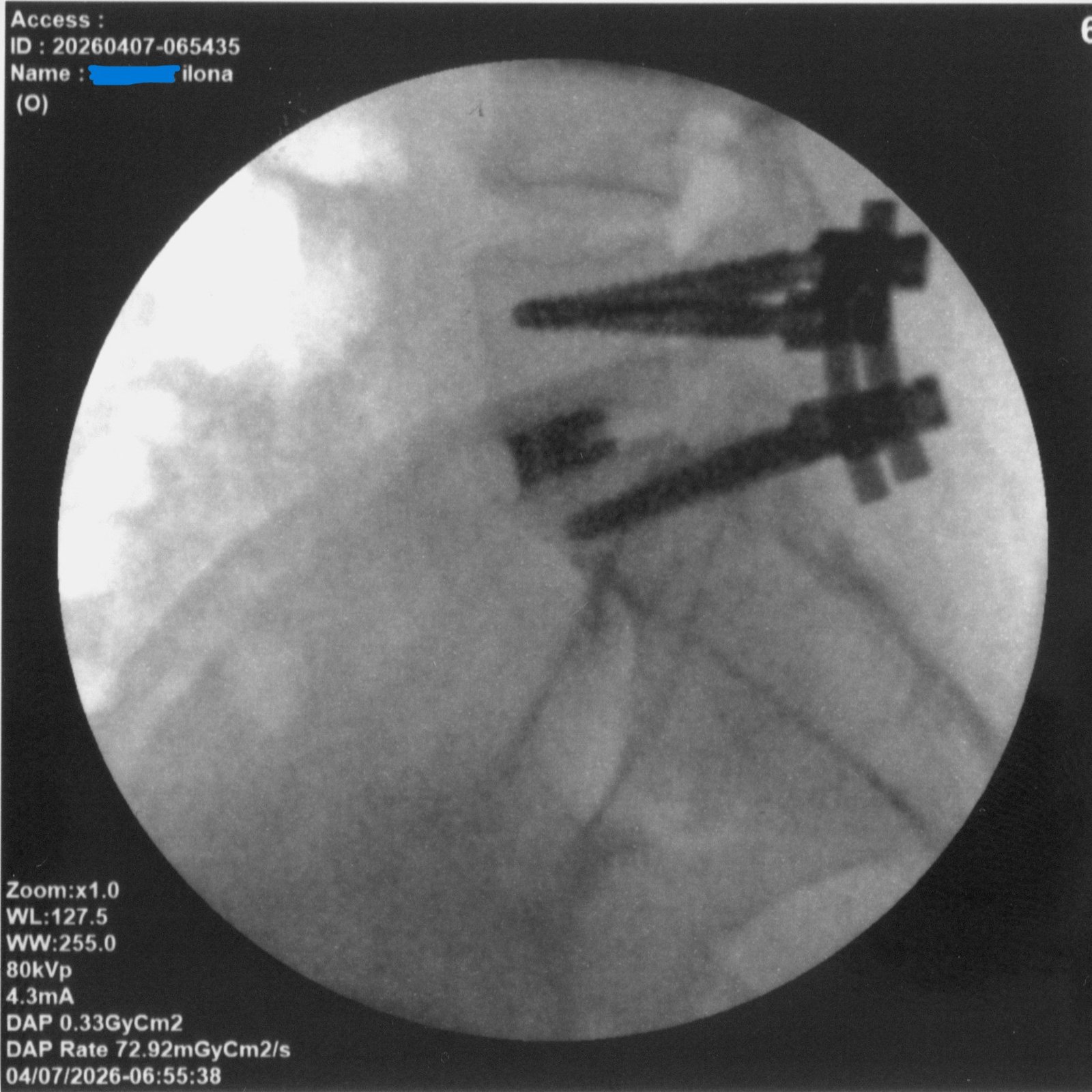 Historia Ilony – 5 lat walki z bólem kręgosłupa, który odebrał normalne życie